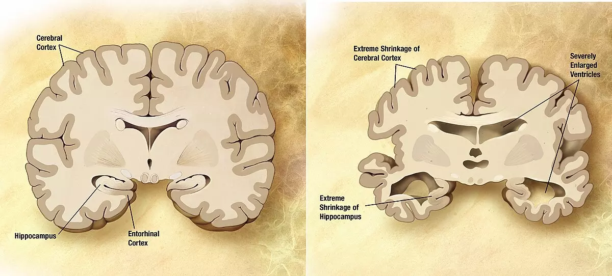 La maladie d'Alzheimer précoce touche de plus en plus de jeunes